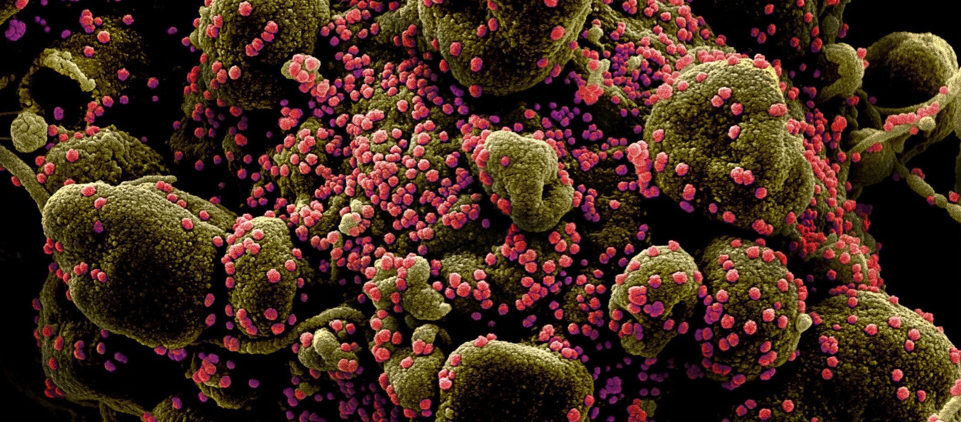 Вид на зараженную коронавирусом клетку под микроскопом - Sputnik Արմենիա, 1920, 17.05.2021