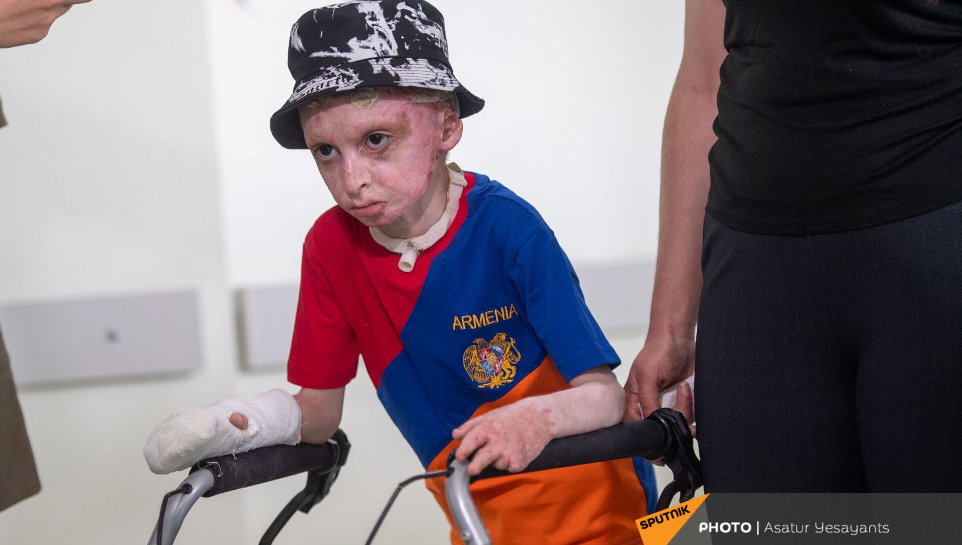 8-летний Ваге Мосинян, получивший 80% ожогов в дорожно-транспортном происшествии, выписывается из больницы через год - Sputnik Արմենիա, 1920, 03.07.2021