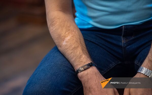 Раненая рука Абета Микаеляна - Sputnik Армения