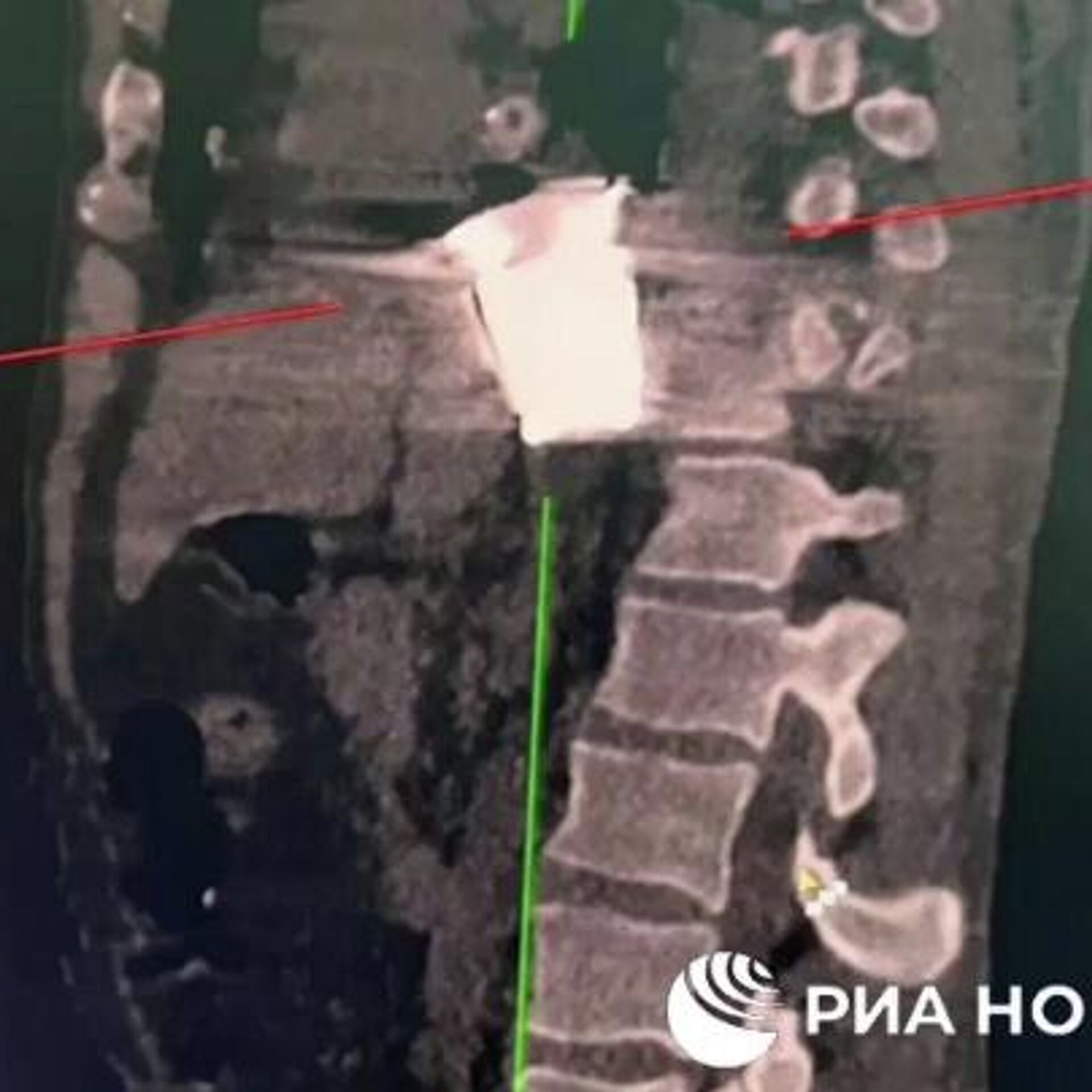 Достали солдата. Неразорвавшийся снаряд. Операция по извлечению неразорвавшегося снаряда. Хирурги достали неразорвавшийся снаряд.